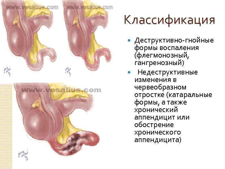 Классификация Деструктивно гнойные формы воспаления (флегмонозный, гангренозный) Недеструктивные изменения в червеобразном отростке (катаральные формы,