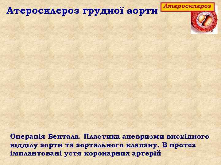 Атеросклероз грудної аорти Атеросклероз Операція Бентала. Пластика аневризми висхідного відділу аорти та аортального клапану.