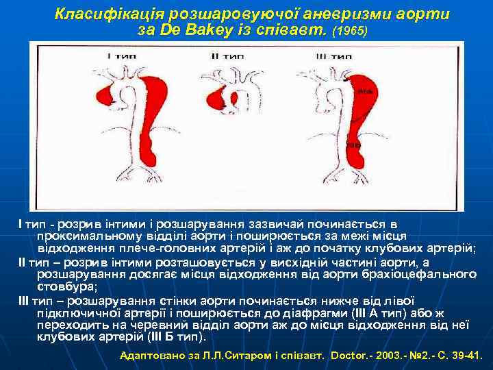 Класифікація розшаровуючої аневризми аорти за De Bakey із співавт. (1965) І тип розрив інтими