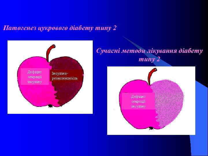 Патогенез цукрового діабету типу 2 Сучасні методи лікування діабету типу 2 Дефіцит секреції інсуліну