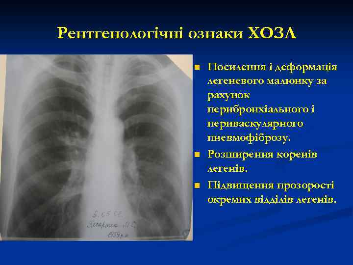 Рентгенологічні ознаки ХОЗЛ n n n Посилення і деформація легеневого малюнку за рахунок перибронхіального