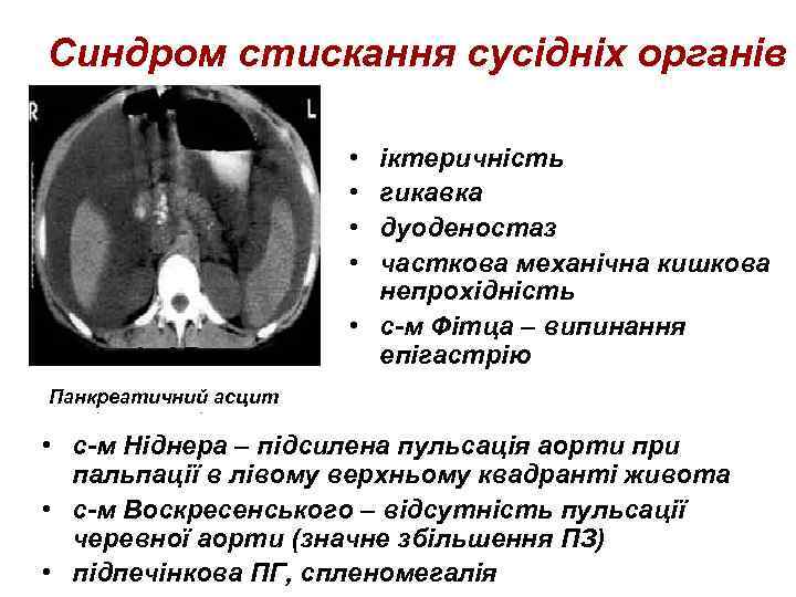Синдром стискання сусідніх органів • • іктеричність гикавка дуоденостаз часткова механічна кишкова непрохідність •