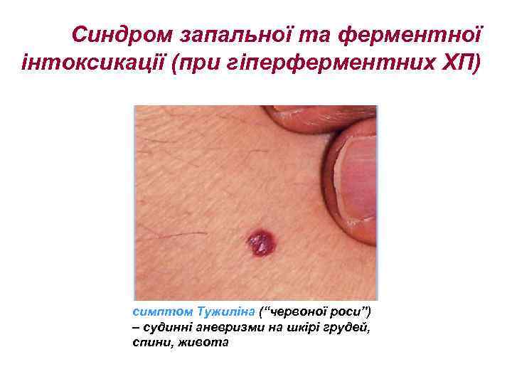 Синдром запальної та ферментної інтоксикації (при гіперферментних ХП) симптом Тужиліна (“червоної роси”) – судинні
