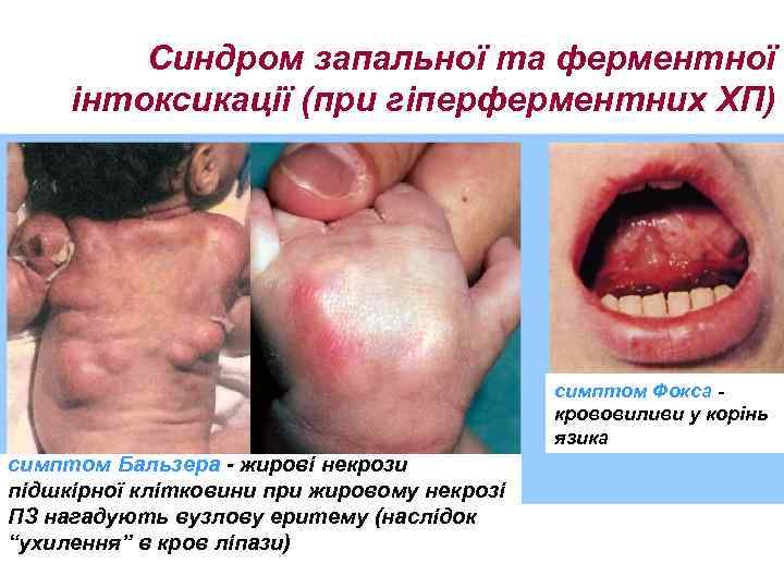 Синдром запальної та ферментної інтоксикації (при гіперферментних ХП) симптом Фокса крововиливи у корінь язика