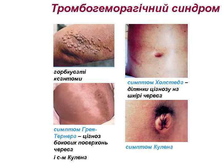 Тромбогеморагічний синдром горбкуваті ксантоми симптом Грея. Тернера – ціаноз бокових поверхонь черева і с-м