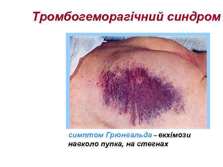Тромбогеморагічний синдром симптом Грюнвальда – екхімози навколо пупка, на стегнах 