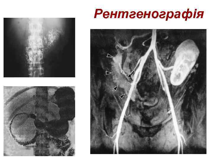 Рентгенографія 