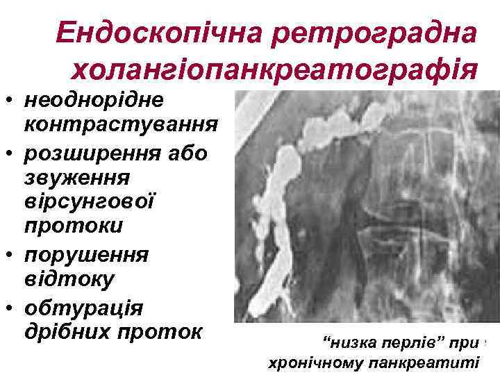 Ендоскопічна ретроградна холангіопанкреатографія • неоднорідне контрастування • розширення або звуження вірсунгової протоки • порушення