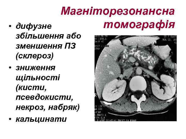 Магніторезонансна томографія • дифузне збільшення або зменшення ПЗ (склероз) • зниження щільності (кисти, псевдокисти,