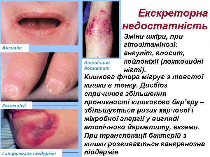 Екскреторна недостатність Ангуліт Койлоніхії Гангренозна піодермія Зміни шкіри, при гіповітамінозі: ангуліт, глосит, койлоніхії (ложковидні