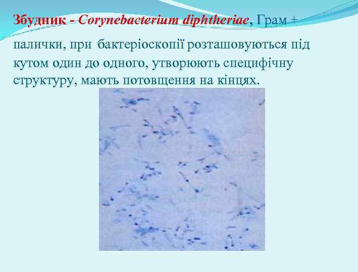 Збудник - Corynebacterium diphtheriae, Грам + палички, при бактеріоскопії розташовуються під кутом один до