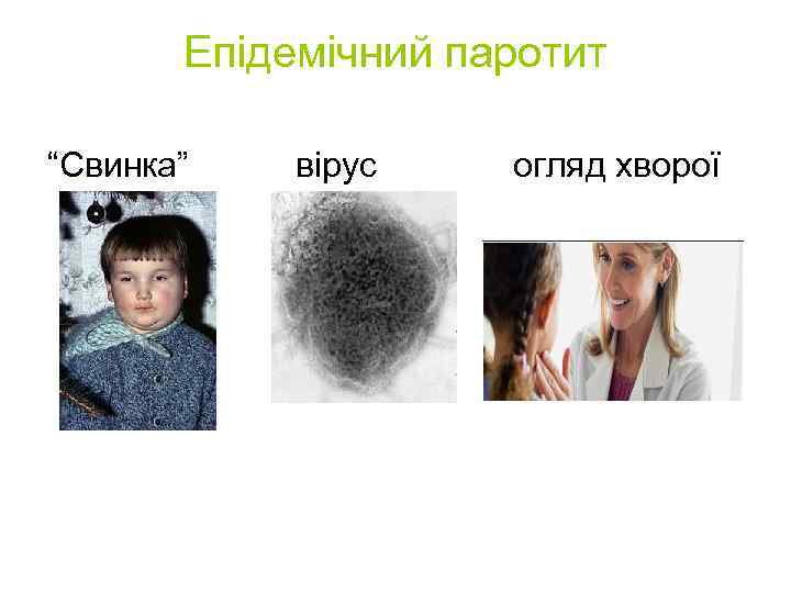 Епідемічний паротит “Свинка” вірус огляд хворої 