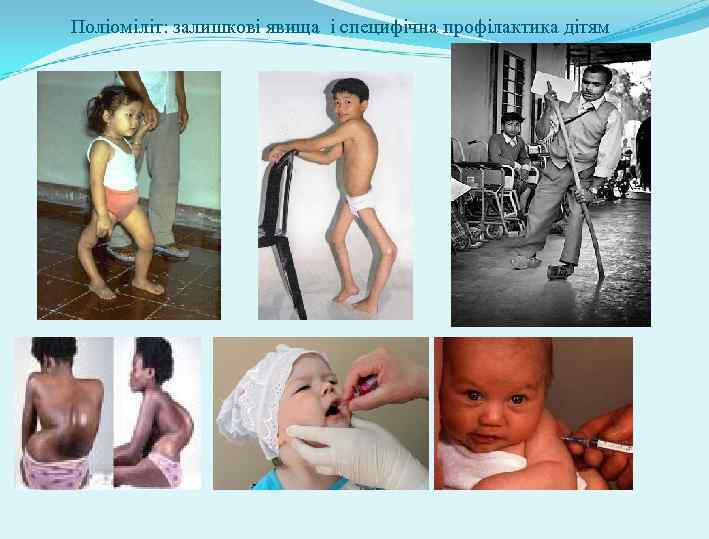  Поліоміліт: залишкові явища і специфічна профілактика дітям 