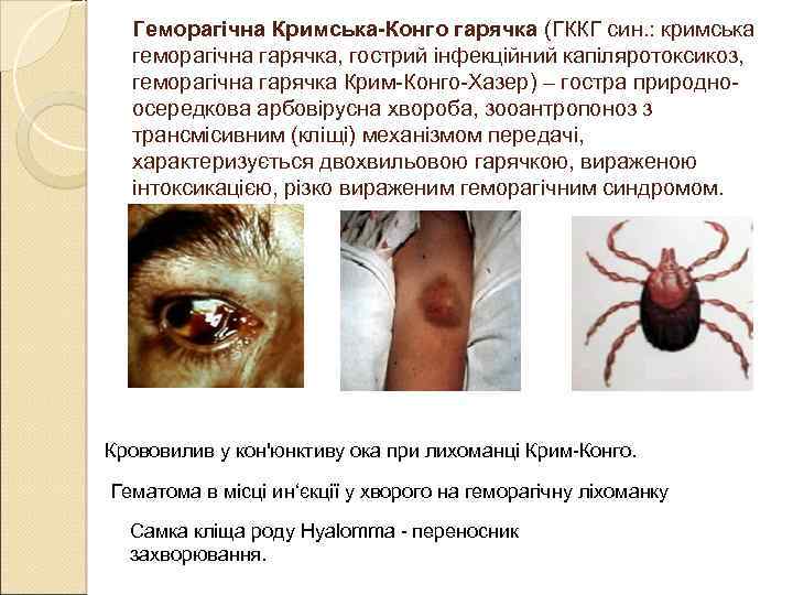 Геморагічна Кримська-Конго гарячка (ГККГ син. : кримська геморагічна гарячка, гострий інфекційний капіляротоксикоз, геморагічна гарячка