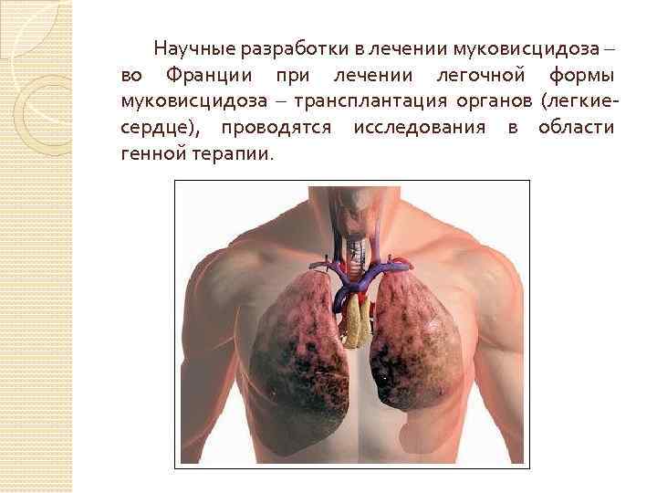  Научные разработки в лечении муковисцидоза – во Франции при лечении легочной формы муковисцидоза