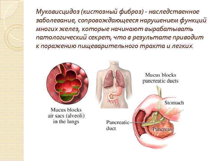 Муковисцидоз что это