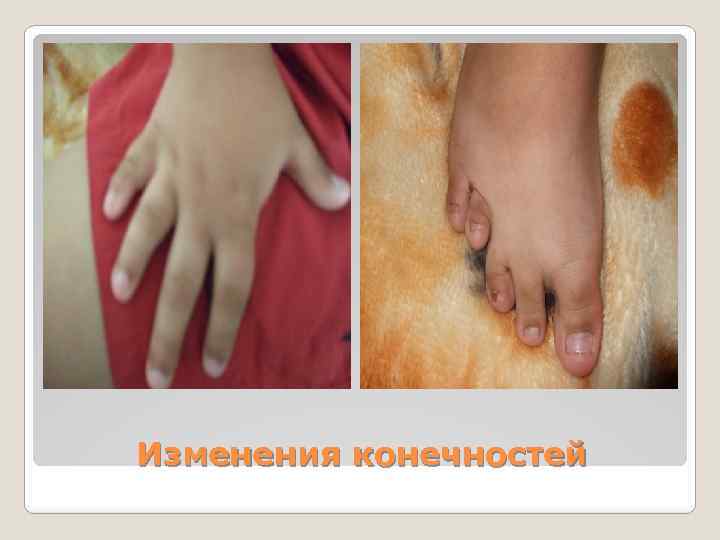 Изменения конечностей 