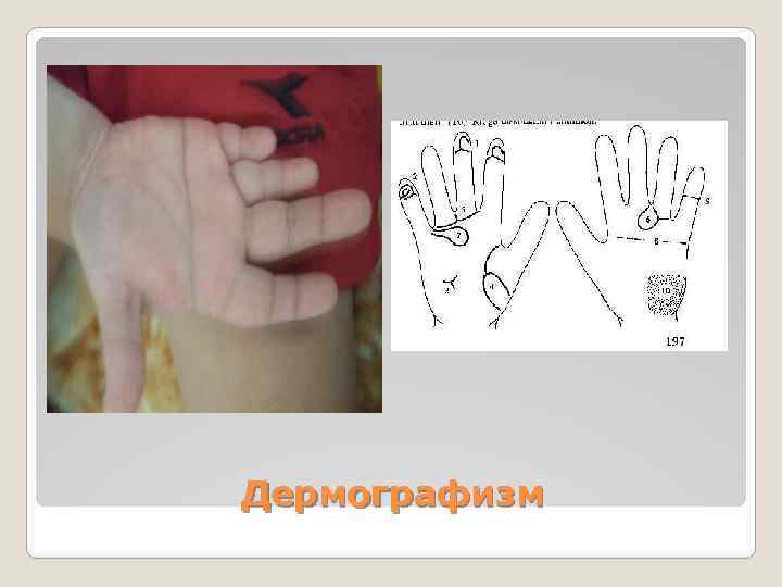 Дермографизм 