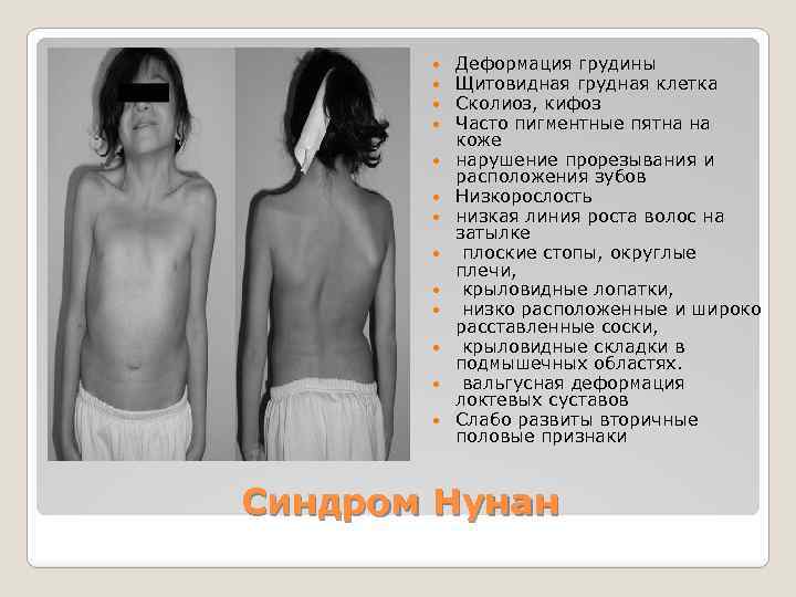  Деформация грудины Щитовидная грудная клетка Сколиоз, кифоз Часто пигментные пятна на коже нарушение