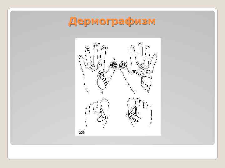 Дермографизм 
