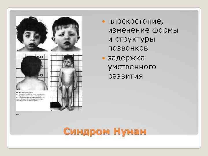 плоскостопие, изменение формы и структуры позвонков задержка умственного развития Синдром Нунан 
