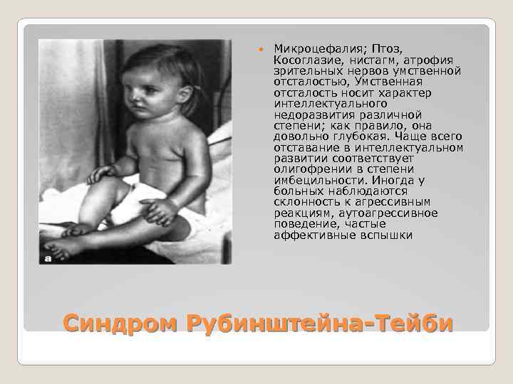  Микроцефалия; Птоз, Косоглазие, нистагм, атрофия зрительных нервов умственной отсталостью, Умственная отсталость носит характер