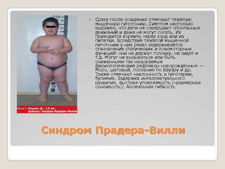  Сразу после рождения отмечают тяжёлую мышечную гипотонию. Симптом настолько выражен, что дети не