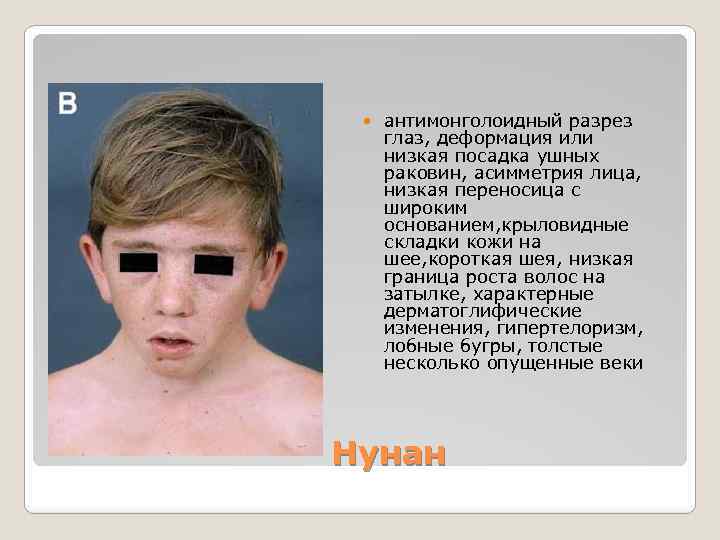  антимонголоидный разрез глаз, деформация или низкая посадка ушных раковин, асимметрия лица, низкая переносица