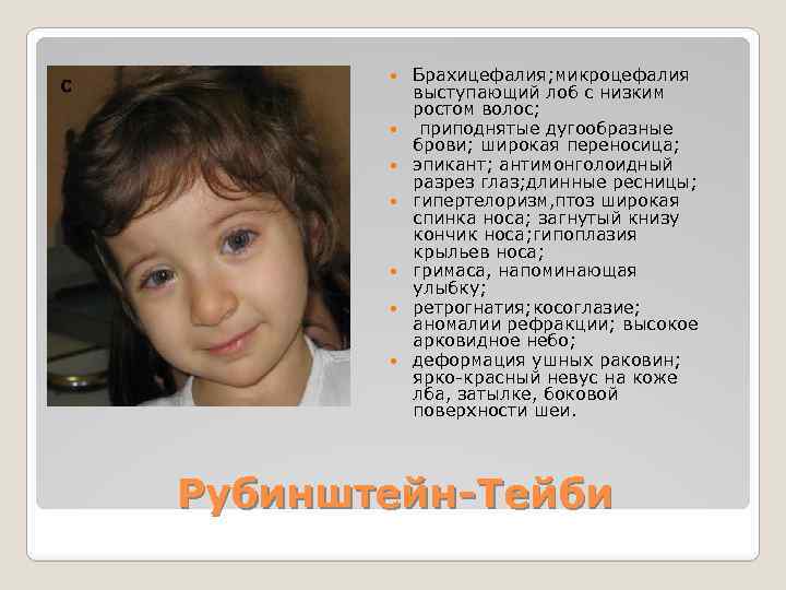  Брахицефалия; микроцефалия выступающий лоб с низким ростом волос; приподнятые дугообразные брови; широкая переносица;