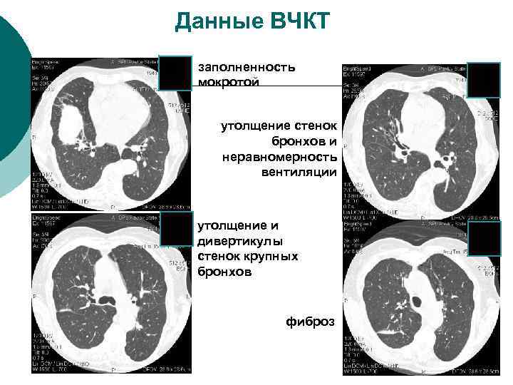 Данные ВЧКТ заполненность мокротой утолщение стенок бронхов и неравномерность вентиляции утолщение и дивертикулы стенок