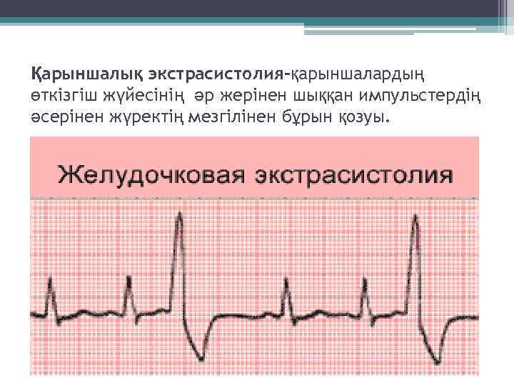 Қарыншалық экстрасистолия-қарыншалардың өткізгіш жүйесінің әр жерінен шыққан импульстердің әсерінен жүректің мезгілінен бұрын қозуы. 