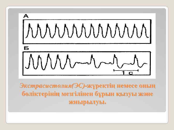 Экстрасистолия(ЭС)-жүректің немесе оның бөліктерінің мезгілінен бұрын қызуы және жиырылуы. 