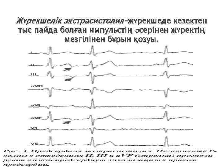 Жүрекшелік экстрасистолия-жүрекшеде кезектен тыс пайда болған импульстің әсерінен жүректің мезгілінен бұрын қозуы. 