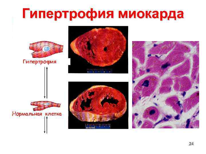 Гипертрофия миокарда Гипертрофия Нормальная клетка 24 