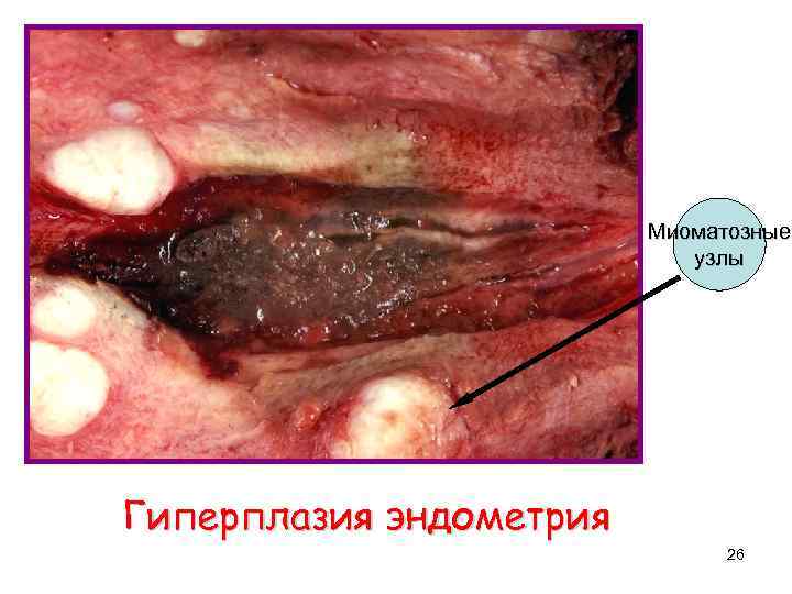 Миоматозные узлы Гиперплазия эндометрия 26 