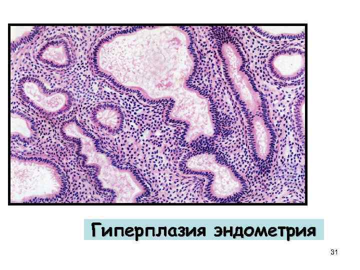 Гиперплазия эндометрия 31 