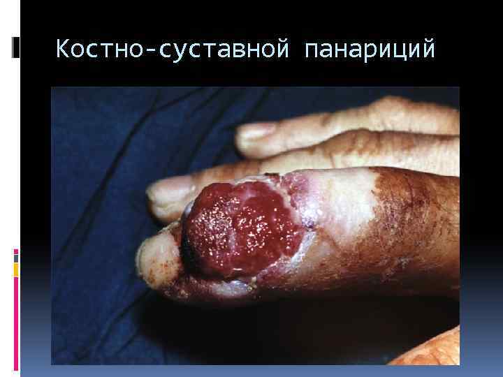 Костно-суставной панариций 