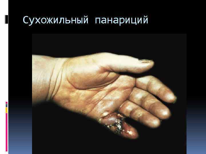 Сухожильный панариций 