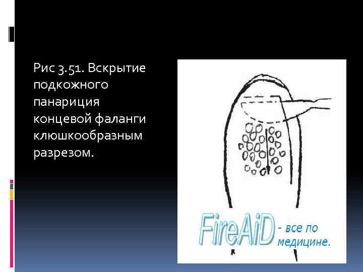 Рис 3. 51. Вскрытие подкожного панариция концевой фаланги клюшкообразным разрезом. 