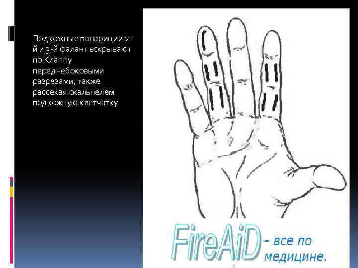 Подкожные панариции 2 й и 3 -й фаланг вскрывают по Клаппу переднебоковыми разрезами, также