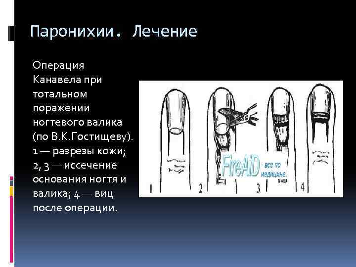 Паронихии. Лечение Операция Канавела при тотальном поражении ногтевого валика (по В. К. Гостищеву). 1