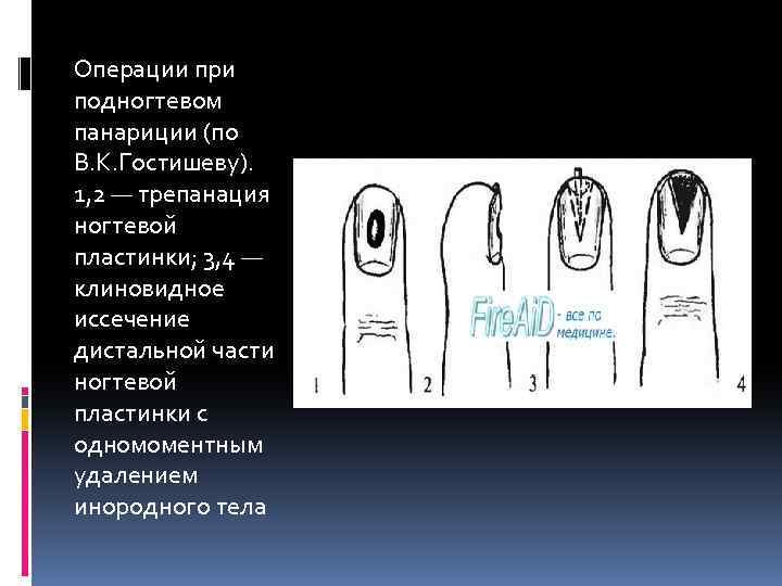 Операции при подногтевом панариции (по В. К. Гостишеву). 1, 2 — трепанация ногтевой пластинки;