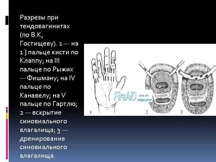 Разрезы при тендовагинитах (по В. К, Гостищеву). 1 — на 1 ] пальце кисти