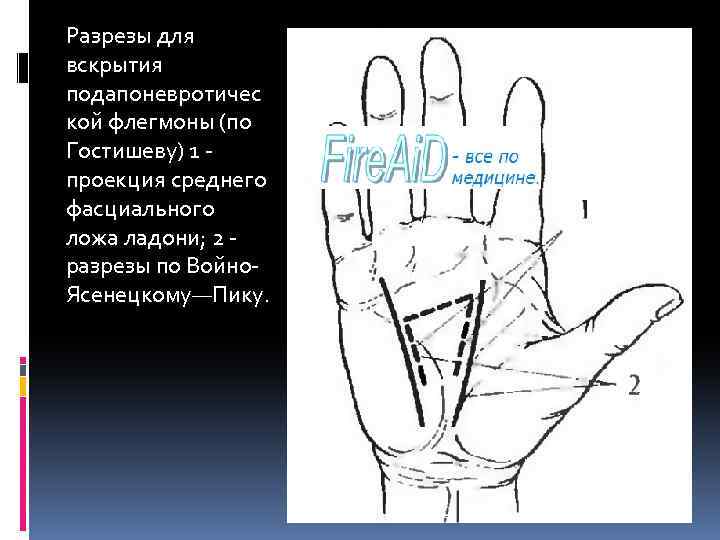 Разрезы для вскрытия подапоневротичес кой флегмоны (по Гостишеву) 1 проекция среднего фасциального ложа ладони;