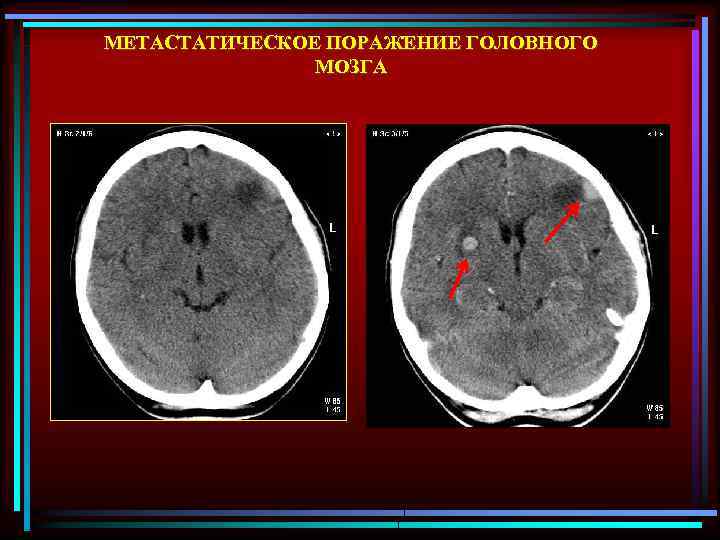 Метастатическое поражение. Метастатическое поражение головного мозга. Методы лучевой диагностики головного мозга.. Лучевая диагностика головной мозг Зартор. Метастатическое поражение головного мозга дислокация.