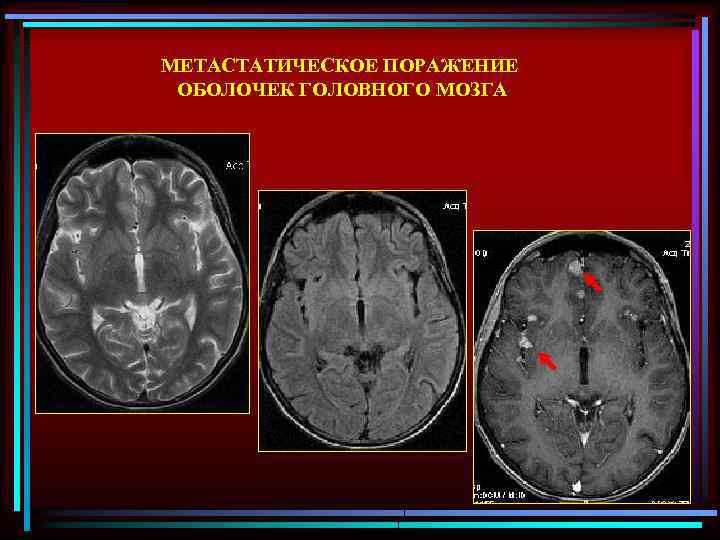 Диагностика головного. Метастатическое поражение головного мозга кт. Лучевая диагностика опухолей головного мозга. Лучевые методы исследования головного мозга. Метастатическое поражение головного мозга мрт.