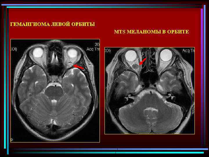 ГЕМАНГИОМА ЛЕВОЙ ОРБИТЫ MTS МЕЛАНОМЫ В ОРБИТЕ 