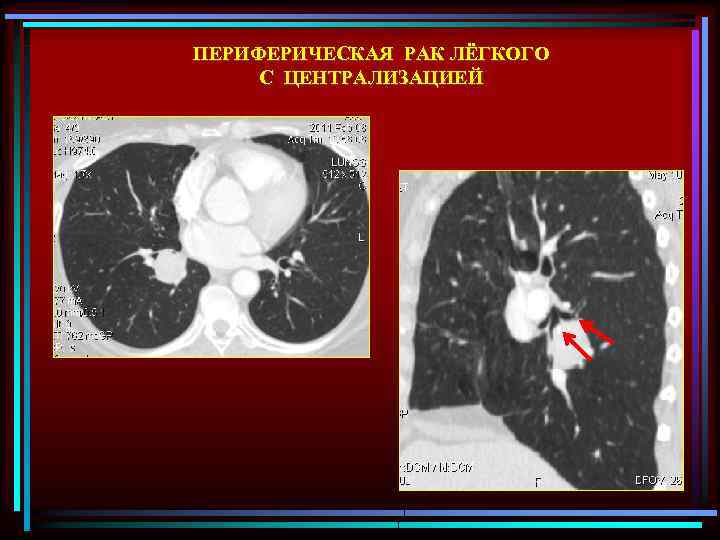 ПЕРИФЕРИЧЕСКАЯ РАК ЛЁГКОГО С ЦЕНТРАЛИЗАЦИЕЙ 