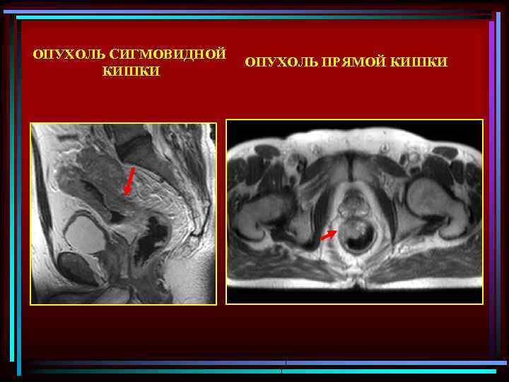 ОПУХОЛЬ СИГМОВИДНОЙ КИШКИ ОПУХОЛЬ ПРЯМОЙ КИШКИ 