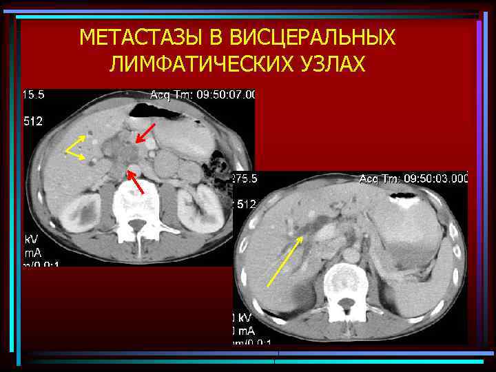 МЕТАСТАЗЫ В ВИСЦЕРАЛЬНЫХ ЛИМФАТИЧЕСКИХ УЗЛАХ 